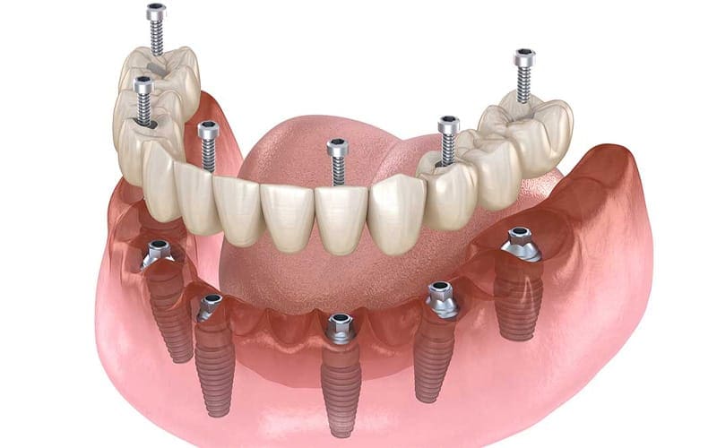 Full Mouth Dental Implants 3 full mouth dental implants