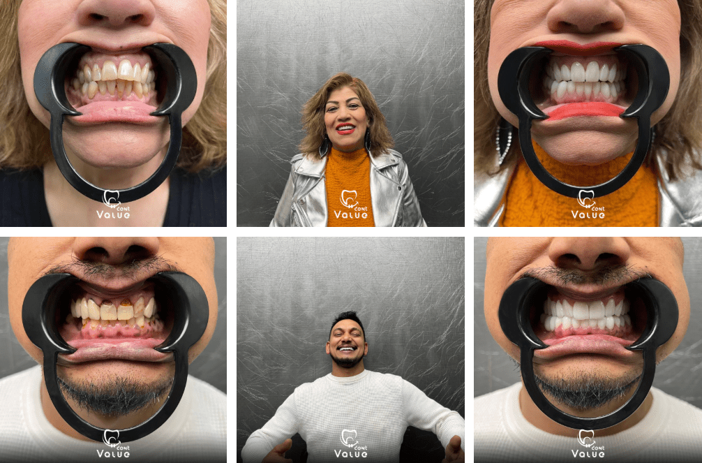 full mouth implants istanbul turkey