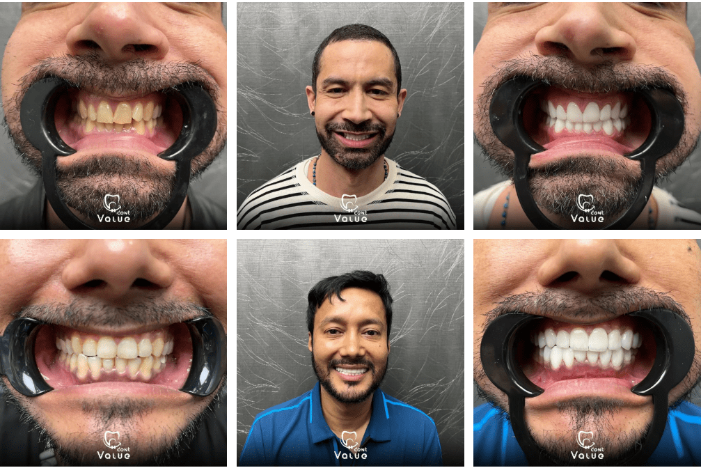 hollywood smile istanbul, turkey before after