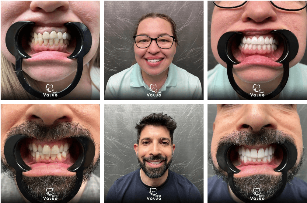 Invisalign 2 gal9
