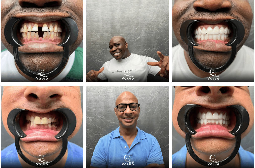 All On 4 Dental Implants Istanbul Turkey all on 6 dis implanti before after