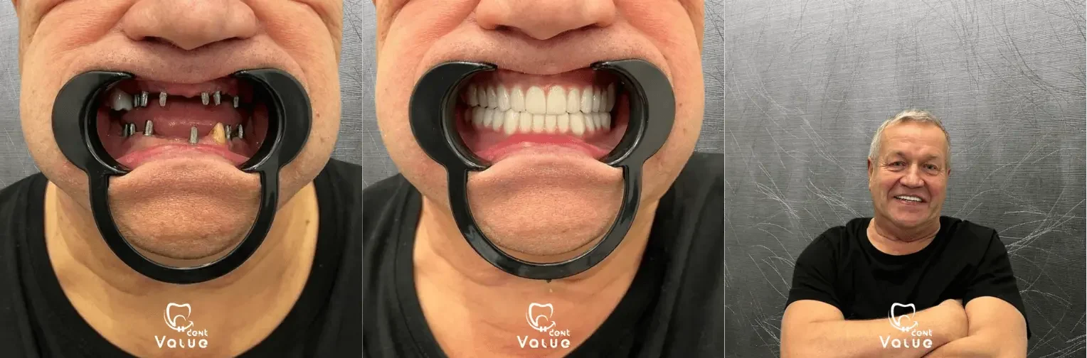 Full Mouth Dental Implants 4 full-mouth-dental-implants-istanbul-turkey-before-after
