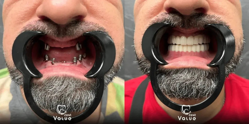 Full Mouth Dental Implants in Istanbul – A Complete Guide with Valuedent Clinic 1 full-mouth-implants-istanbul-before-after