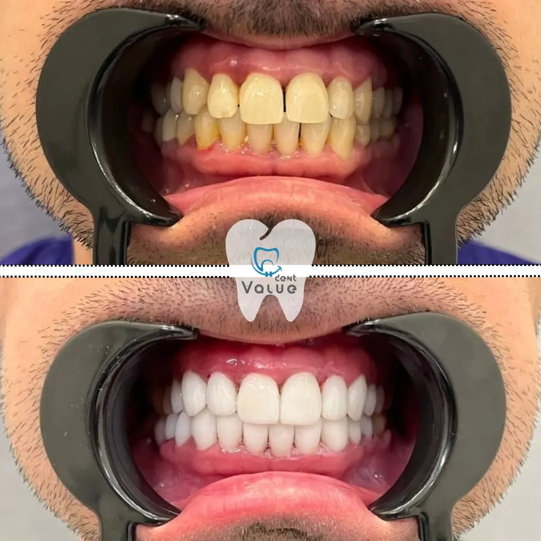 before-and-after-hollywood-smile