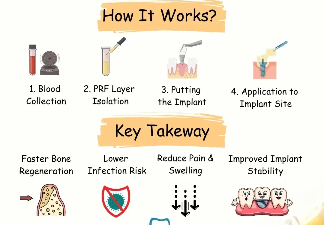 dental-implant-by-prf-technique