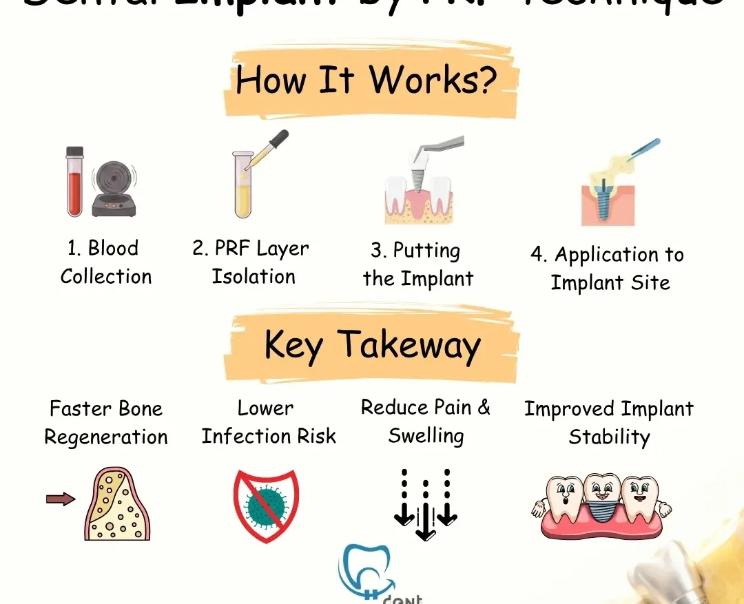 dental-implant-by-prf-technique