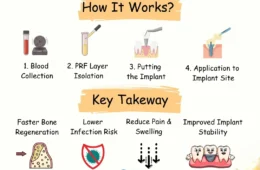 Dental Implant By (PRF) Platelet-Rich Fibrin Technique