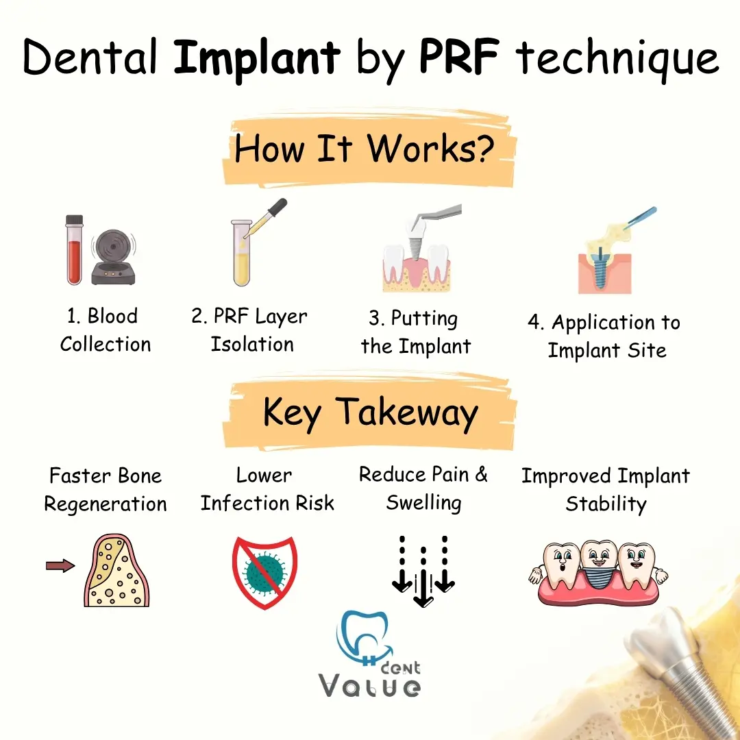 dental implant by prf technique