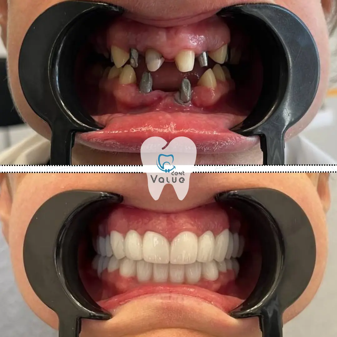 dental-implants-before-after-in-istanbul