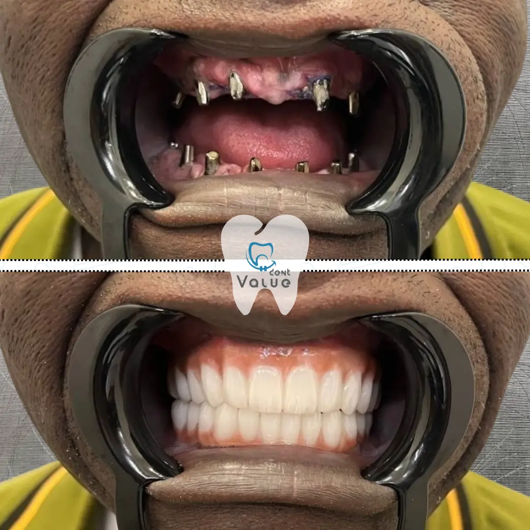 dental-implants-before-after-in-turkey