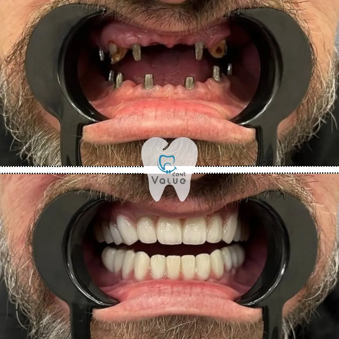 dental-implants-before-after