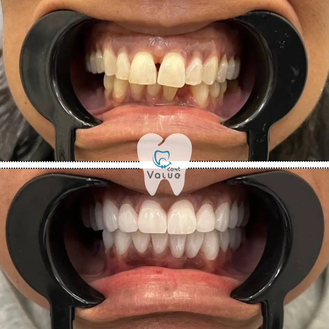 dental-veneers-istanbul-turkey