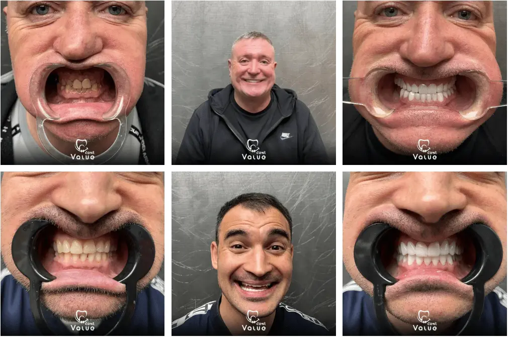 emax-veneers-gallery