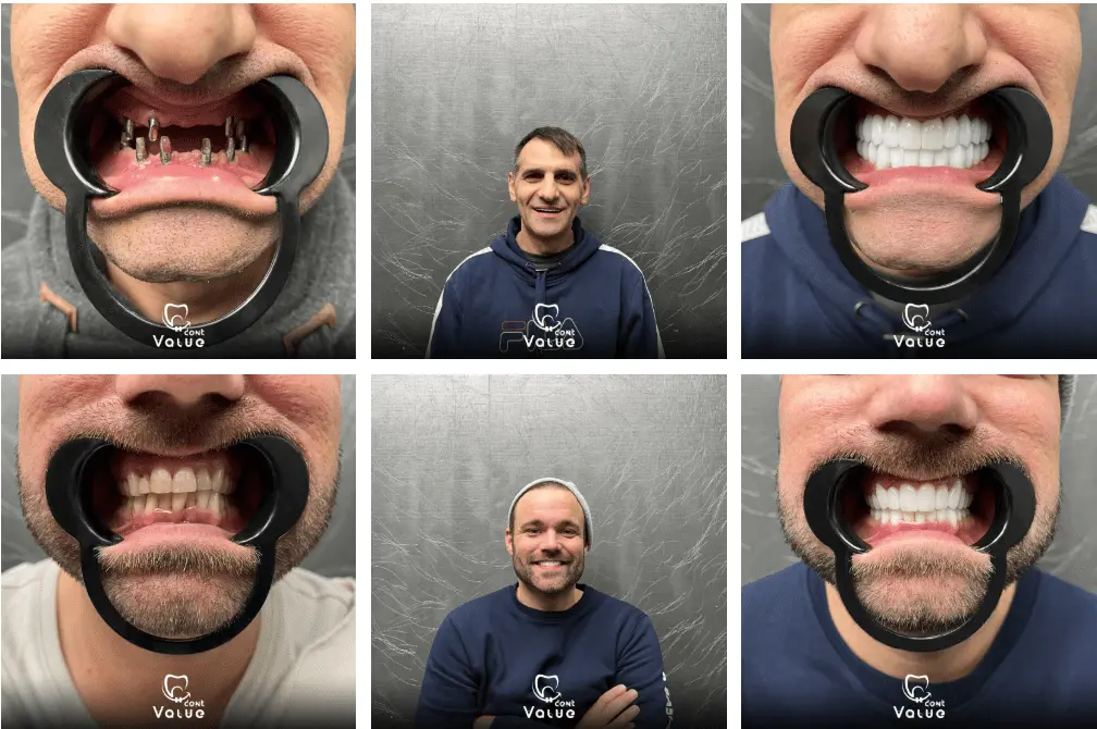 full-mouth-implant-gallery
