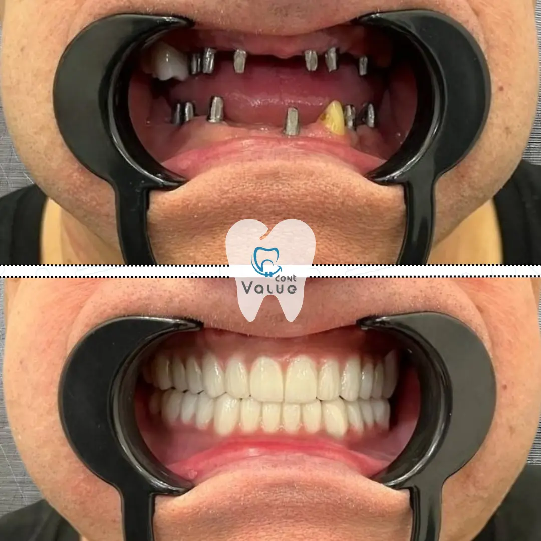 full-mouth-implants-before-after-in-istanbul