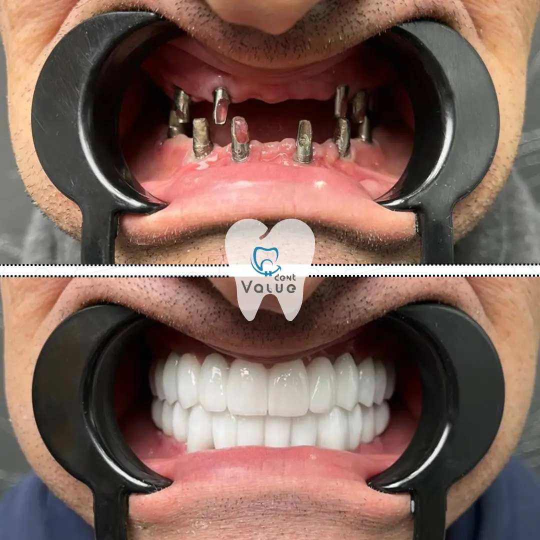 full-mouth-implants-before-after-in-turkey