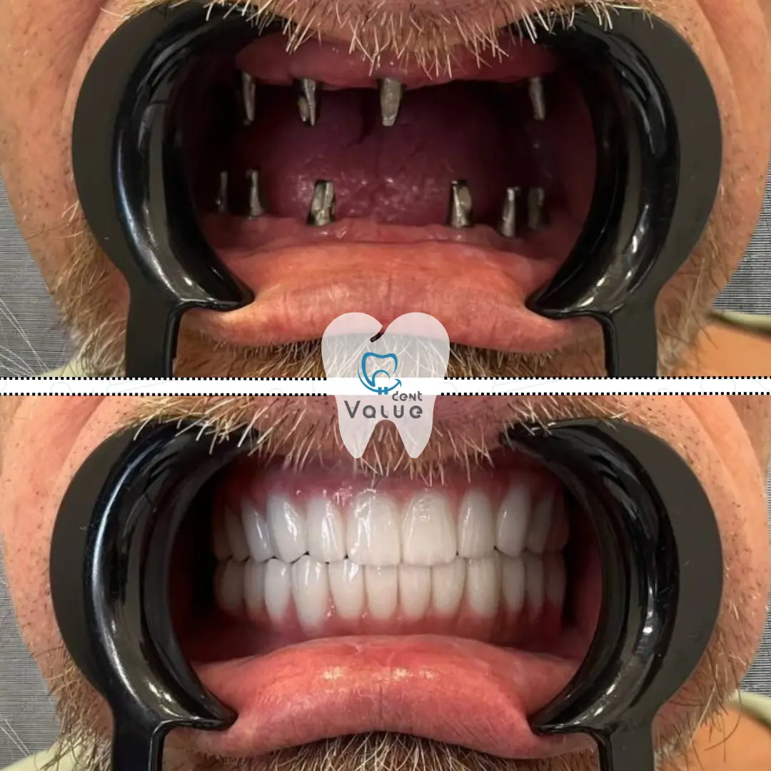 full-mouth-implants-before-after