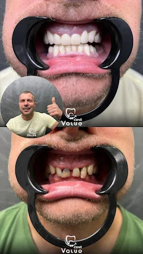 hollywood-smile-before-after-pictures-in-istanbul-turkey