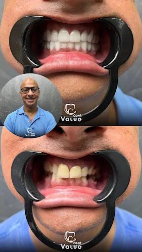 hollywood-smile-before-after-turkey