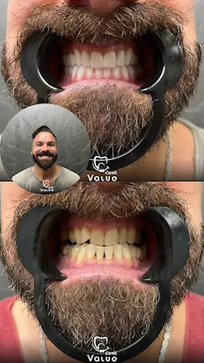 hollywood-smile-before-after