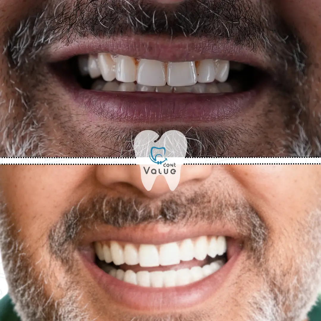 hollywood-smile-before-and-after