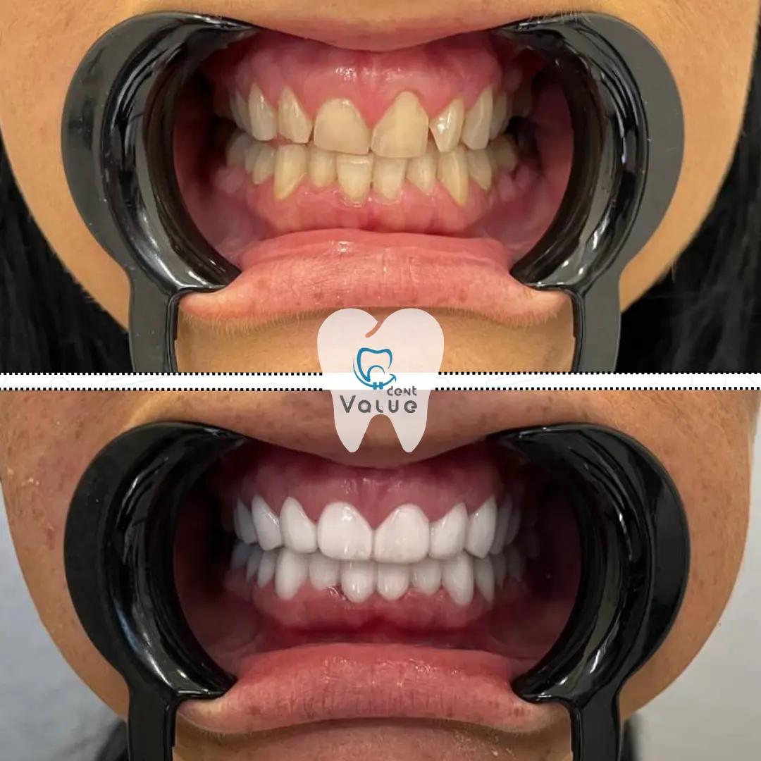 hollywood-smile-makeover