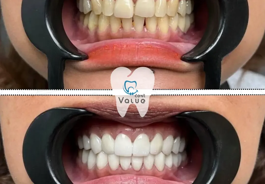 hollywood-smile-turkey