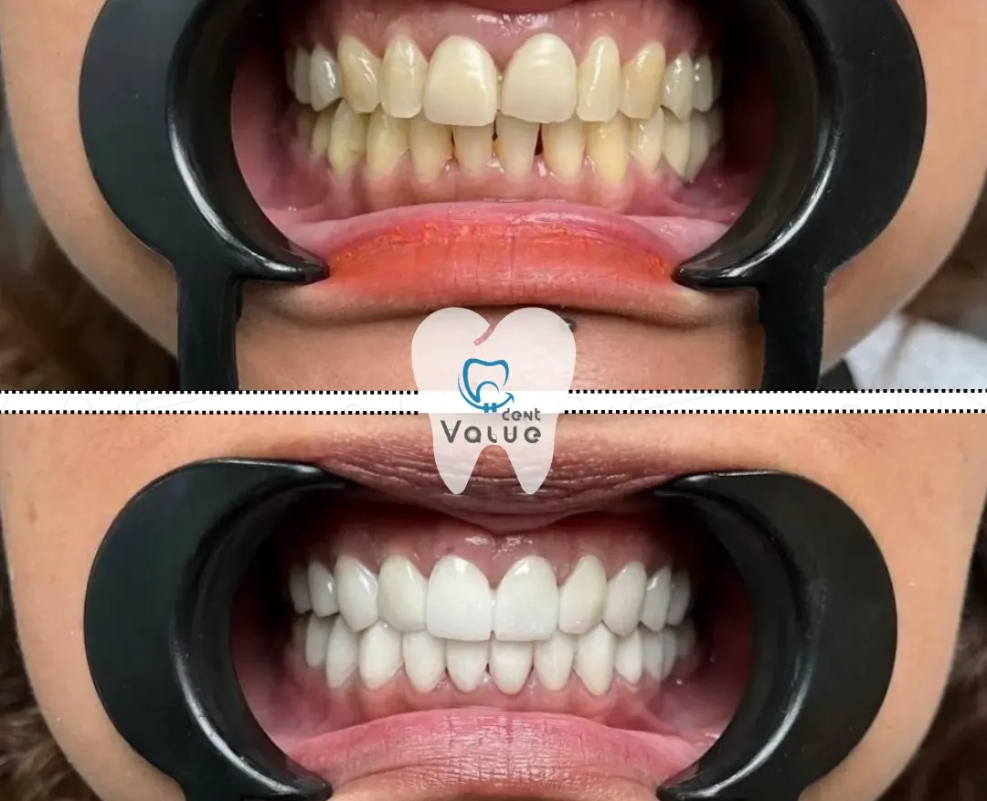 sonrisa-hollywood-turquia