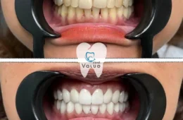 How to Choose Between E-Max Veneers and Zirconia Crowns for Your Hollywood Smile in Istanbul Turkey