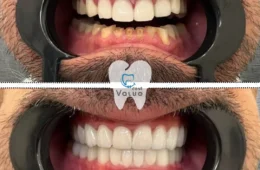 How Digital Smile Design Revolutionizes Smile Makeovers in Istanbul (For UK, US & EU Patients)