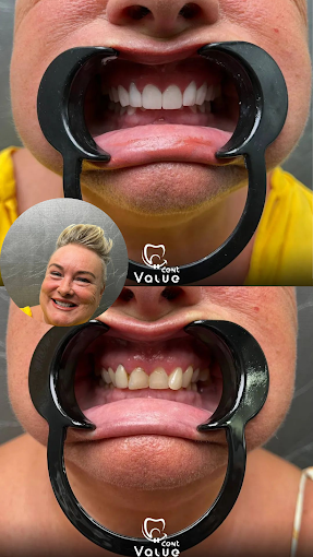patients-veneers-before-after-in-istanbul-turkey