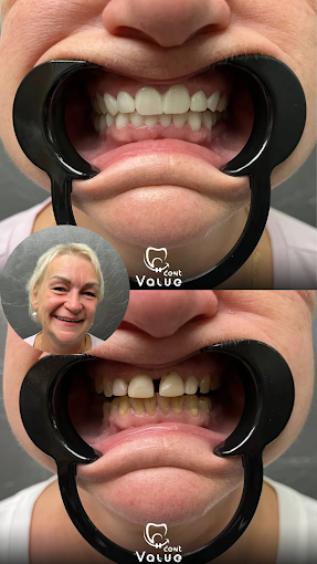patients-veneers-in-istanbul-turkey