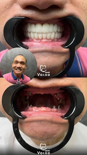 veneers-before-after-in-istanbul-turkey