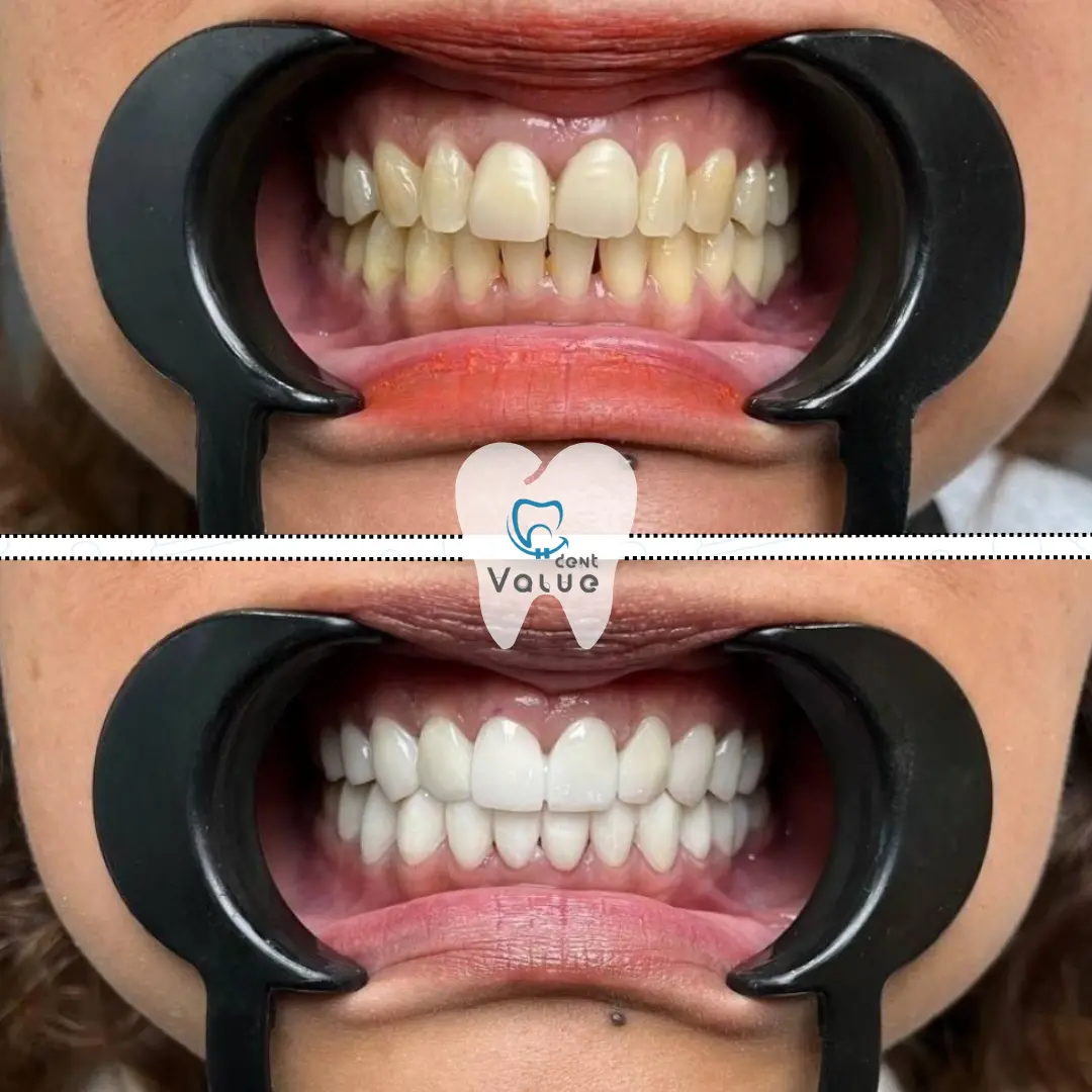 zirconium-crowns-before-after-in-istanbul-turkey