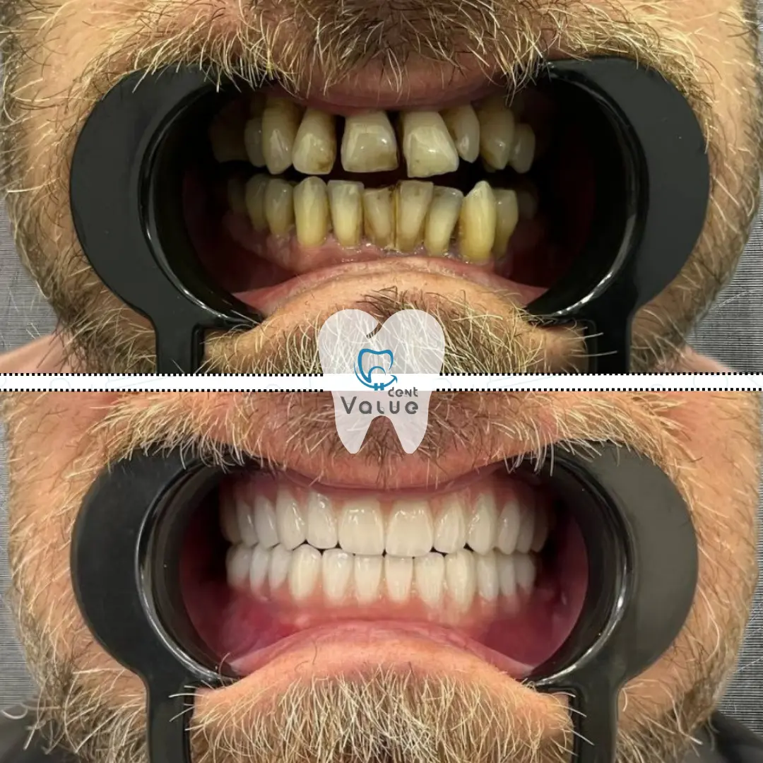 zirconium-crowns-before-after-in-istanbul