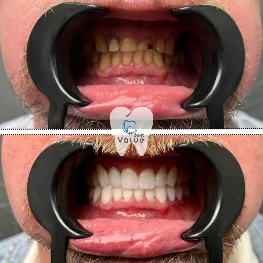 zirconium-crowns-before-after-in-turkey