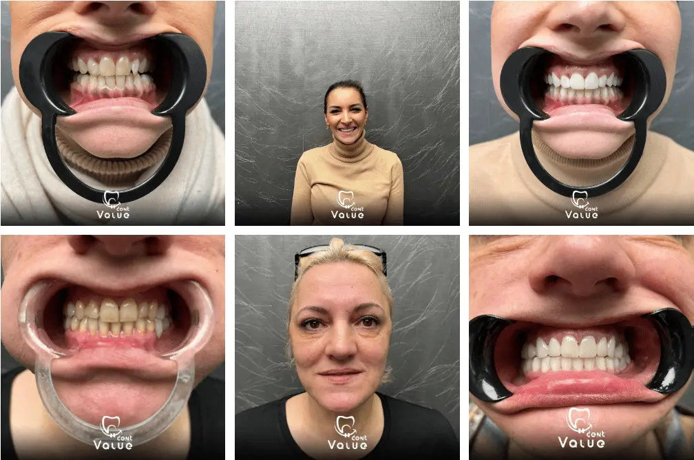 zirconium-crowns-gallery-in-istanbul