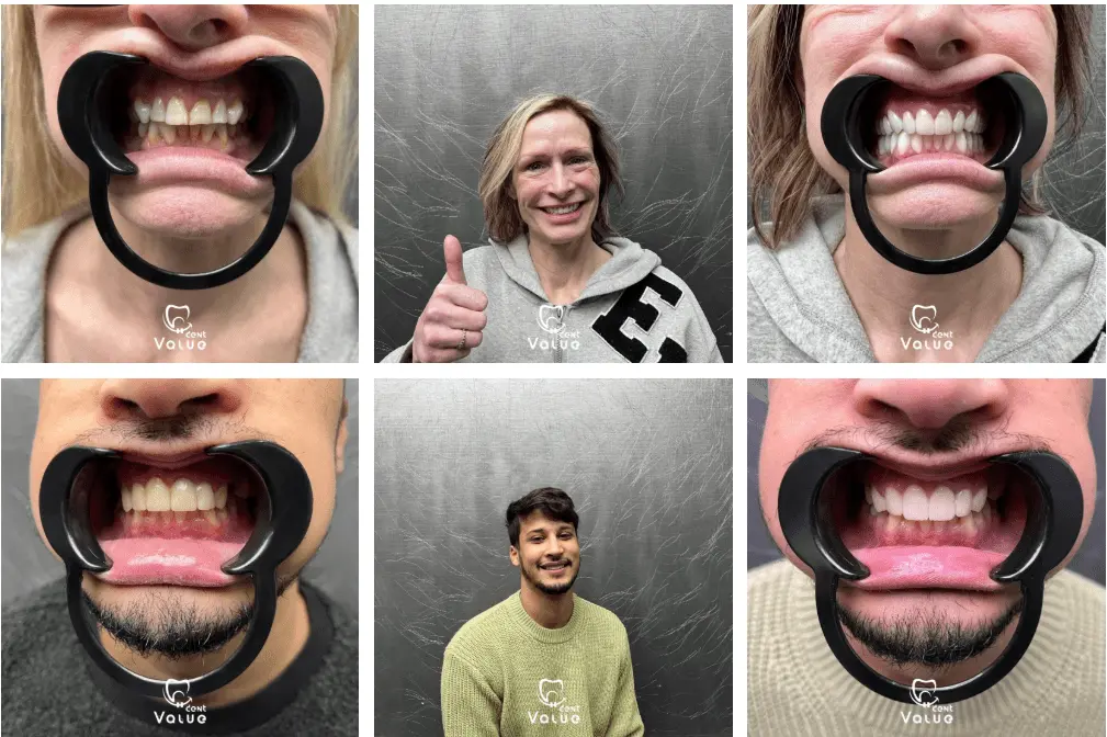 zirconium-crowns-gallery