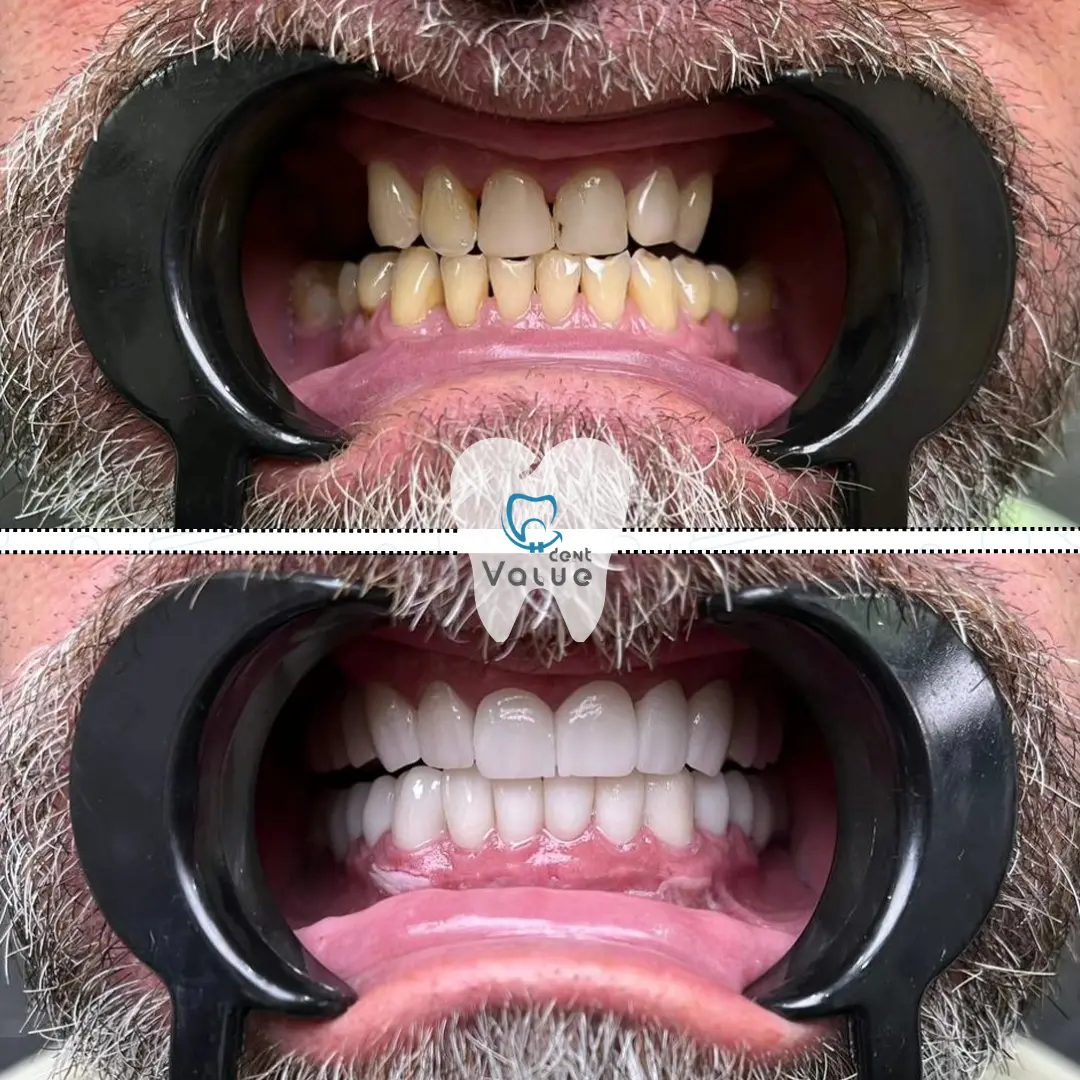 zirconium-crowns-in-istanbul