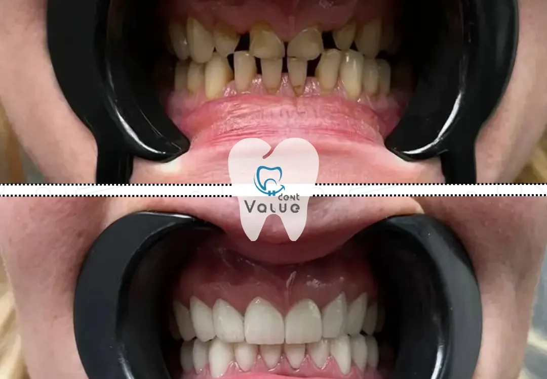 coroane-din-zirconiu-in-turcia