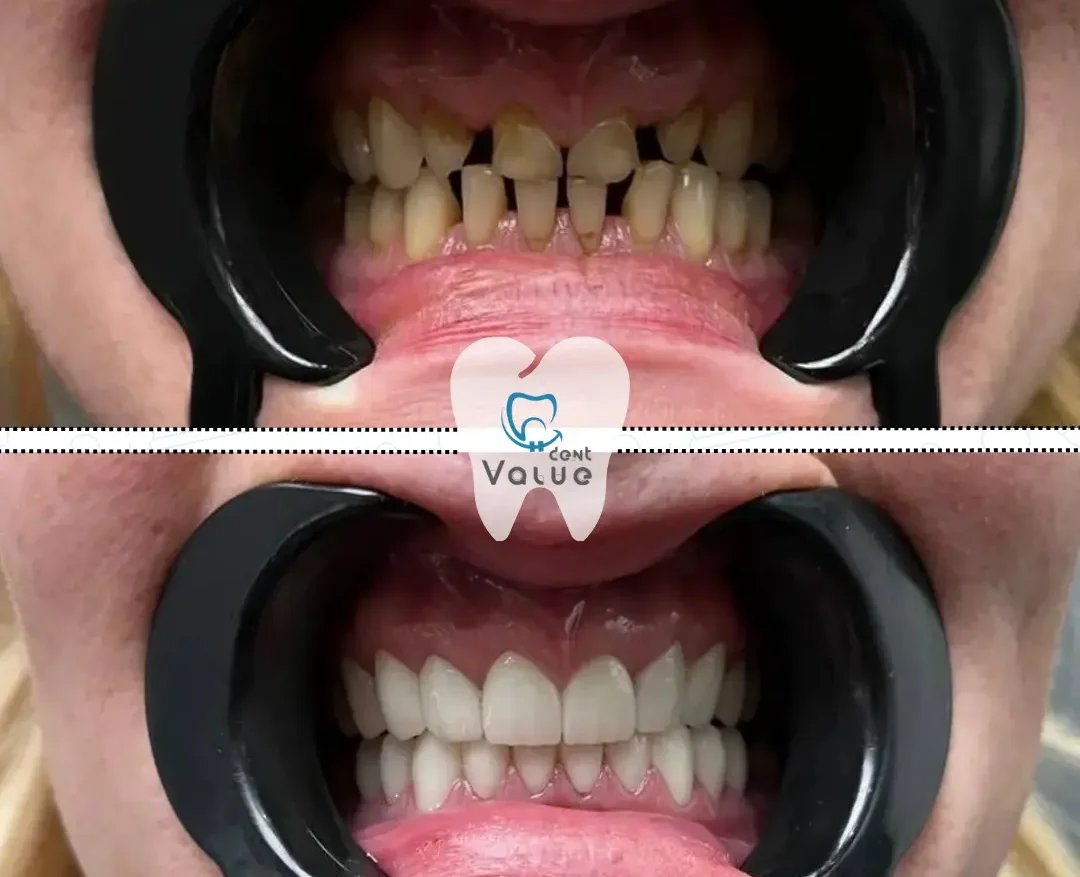 coronas-de-zirconio-en-turquia
