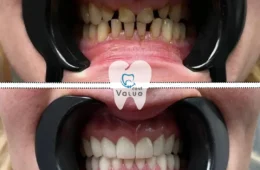 Smile Without the Fear: Exploring Pain-Free Dental Procedures at Valuedent Clinic Istanbul