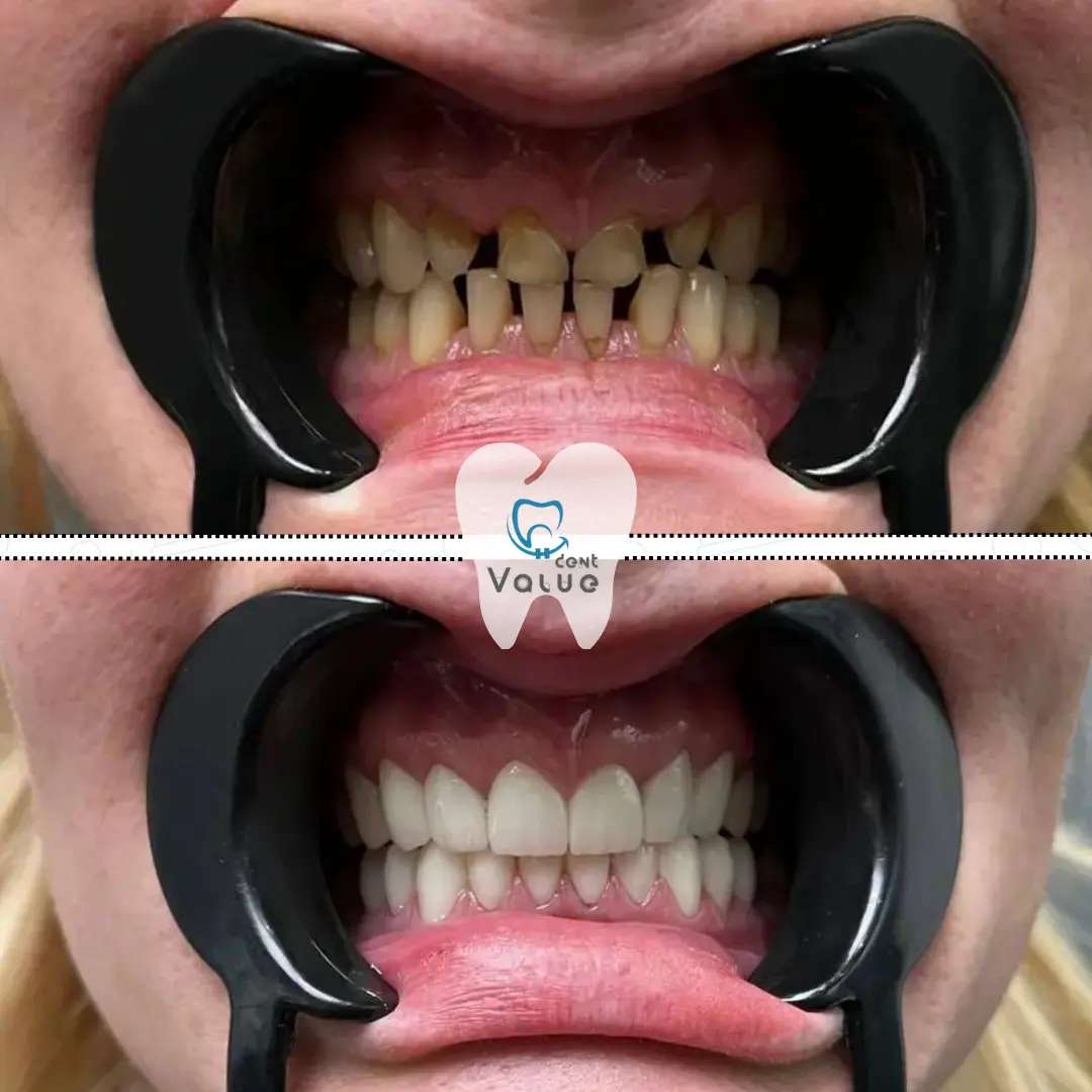 zirconium-crowns-in-turkey