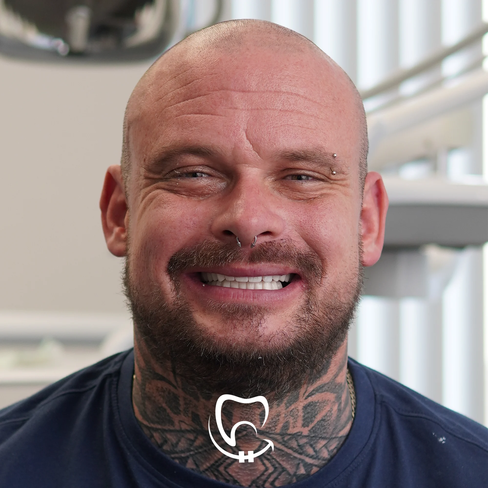 valuedent clinic dental veneers in istanbul turkey after picture