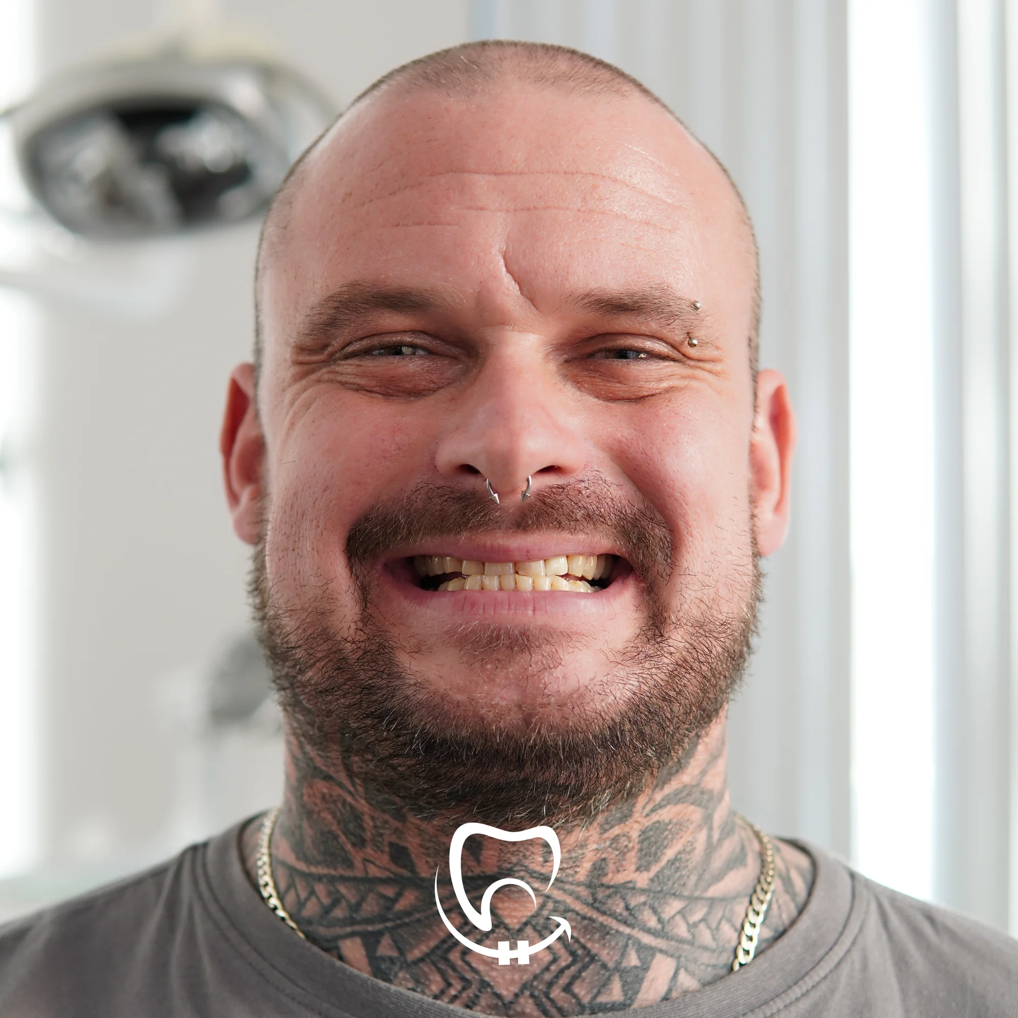 valuedent clinic dental veneers in istanbul turkey before picture