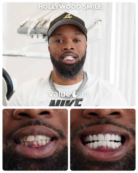 Hollywood Smile