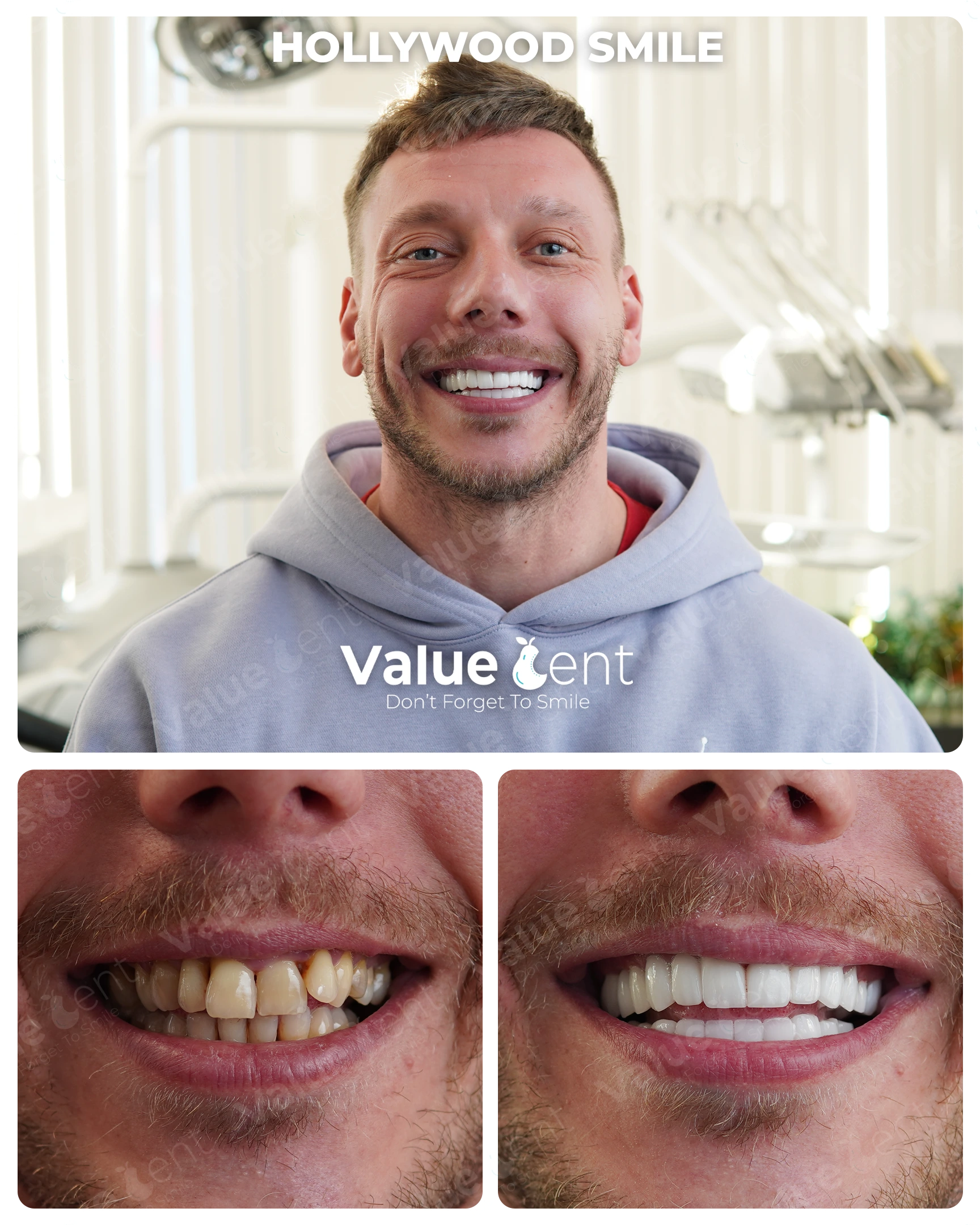 Hollywood Smile Patient ValueDent