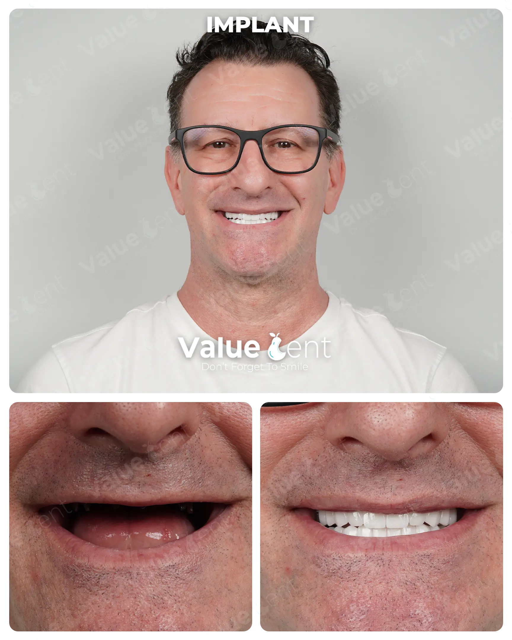 Implants Patient ValueDent