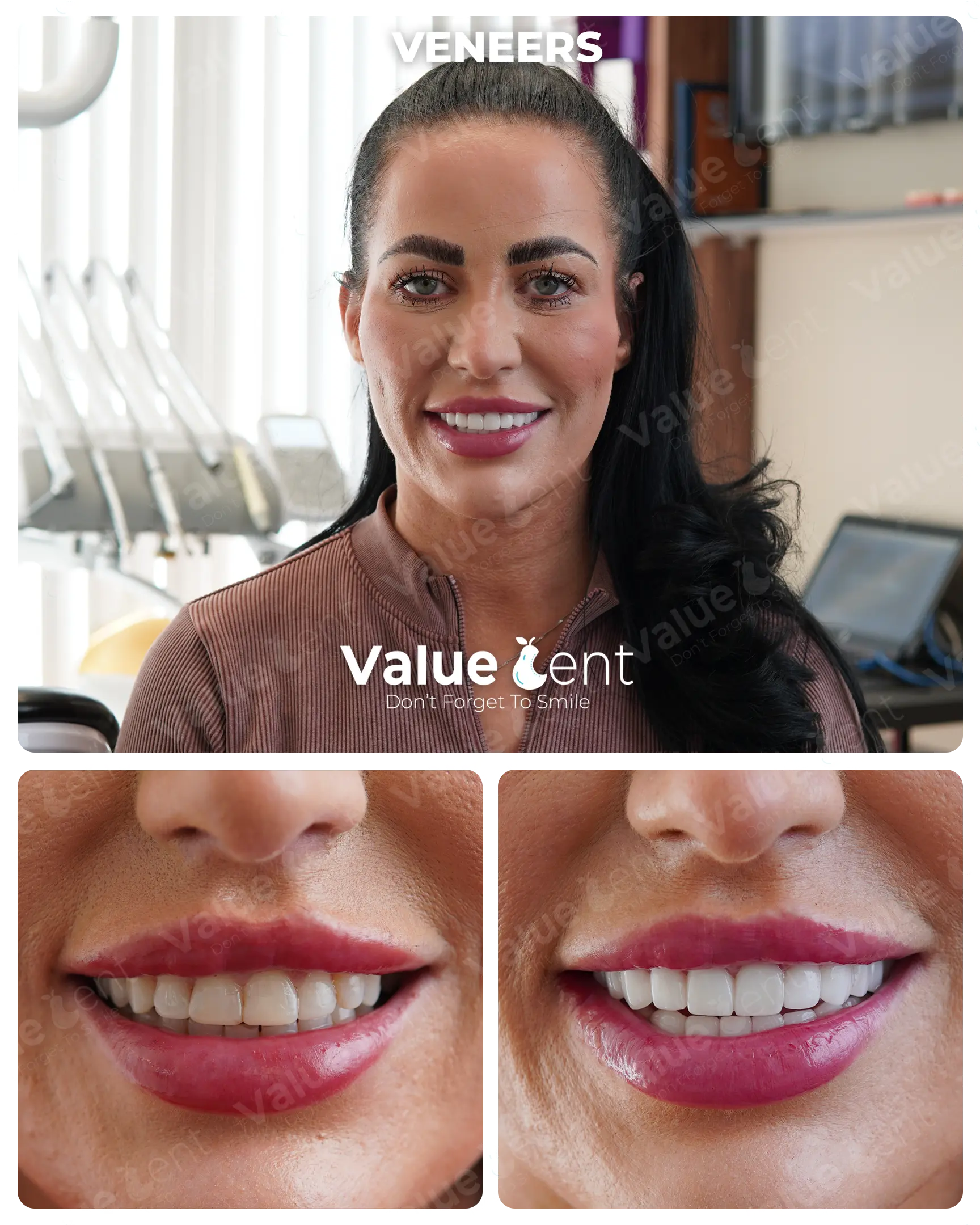 Veneers Patient ValueDent