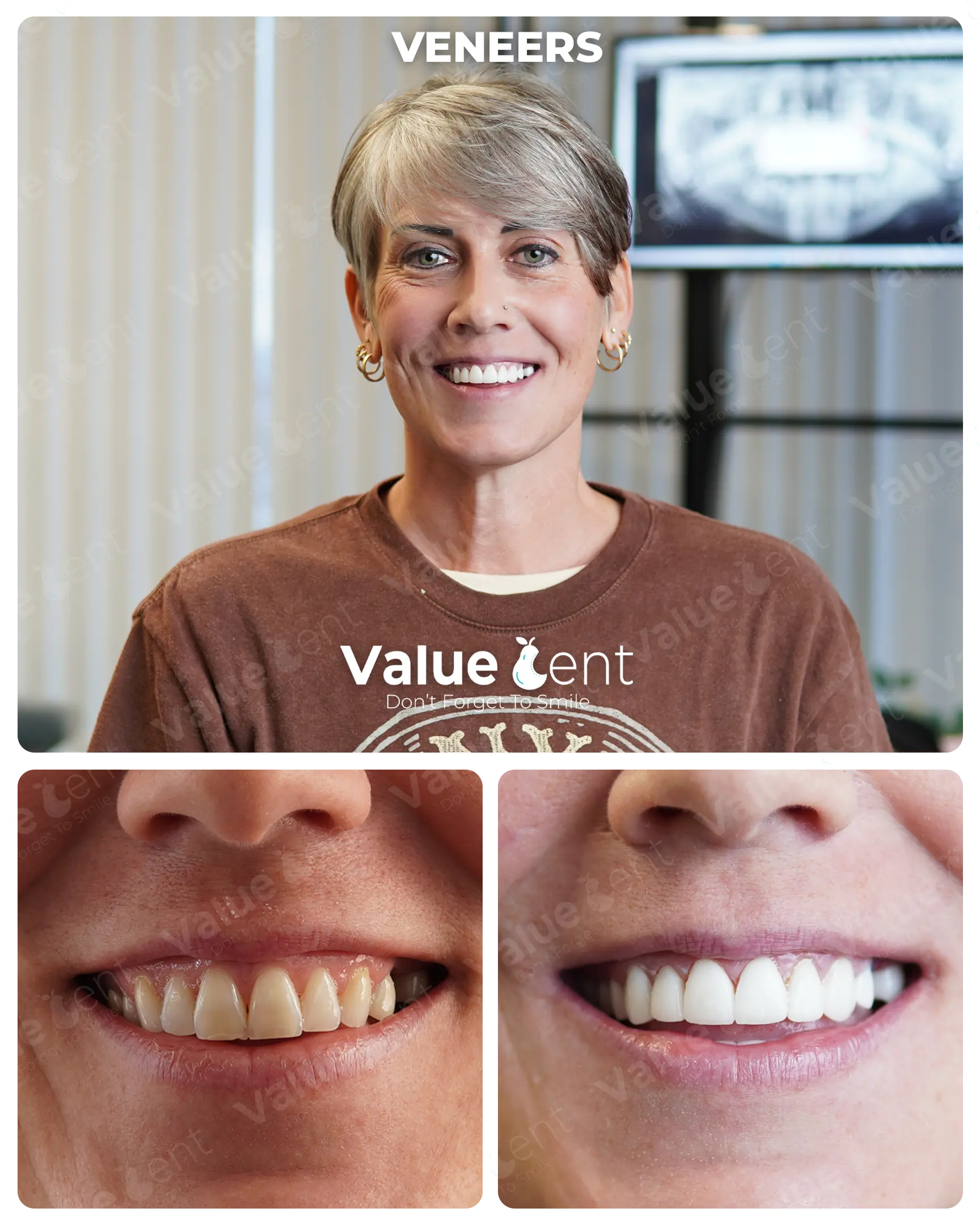 Veneers Patient ValueDent